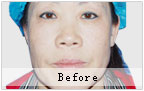 韩式微创除皱对比 美女梦工场成功除皱案例