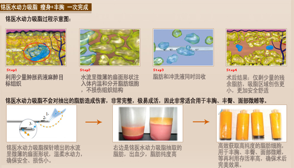 水动力吸脂减肥