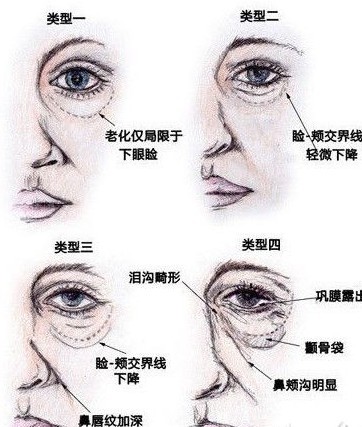 眼周衰老的四种类型的特征