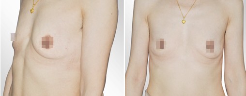 双平面丰胸,美女梦工场,铭医