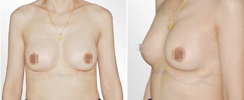 双平面丰胸,美女梦工场,铭医