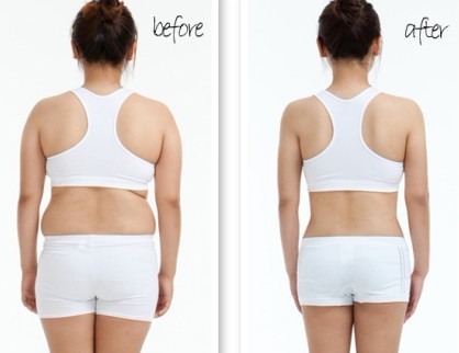 产后吸脂减肥,铭医吸脂减肥,水动力吸脂,吉林铭医