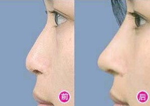 鼻缺损修复,吉林铭医,鼻部整形