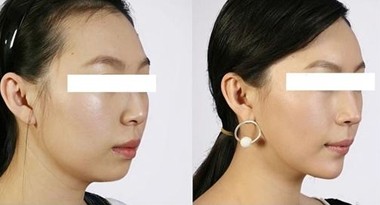 丰下巴术对比,铭医,整形,美容