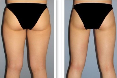 水动力吸脂,吸脂瘦腿