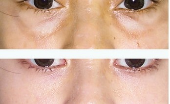 去眼袋术,吉林铭医,眼部整形