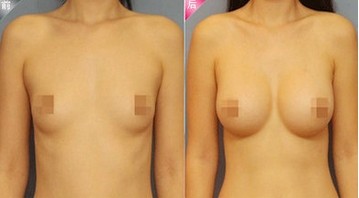 妙桃假体隆胸,吉林铭医,长春隆胸