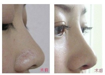 玻尿酸隆鼻,吉林铭医,鼻整形
