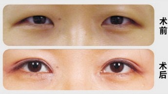 长春铭医,埋线双眼皮,眼部整形