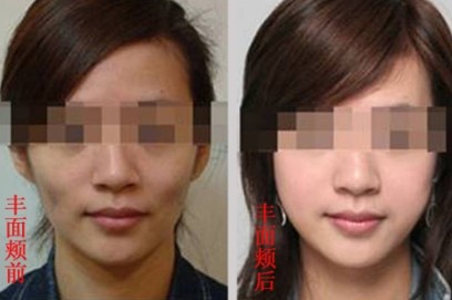 长春微整形专家:选择吉林铭医自体脂肪细胞移植4大理由