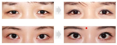 长春眼部整形,开眼角,吉林铭医