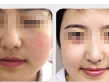 激光术,去除红血丝,吉林铭医