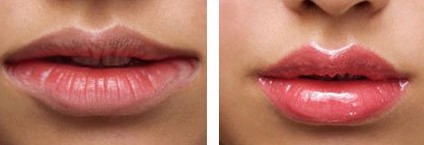 玻尿酸丰唇,铭医