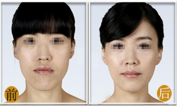 我在铭医做下颌角整形的经历