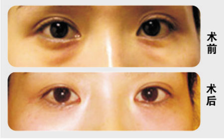 祛眼袋手术,铭医,祛眼袋手术让我在40岁重拾年轻