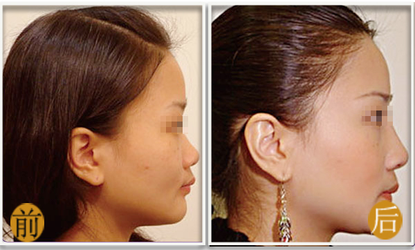 注射填充,吉林铭医