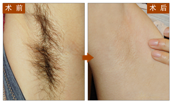 激光脱毛,吉林铭医