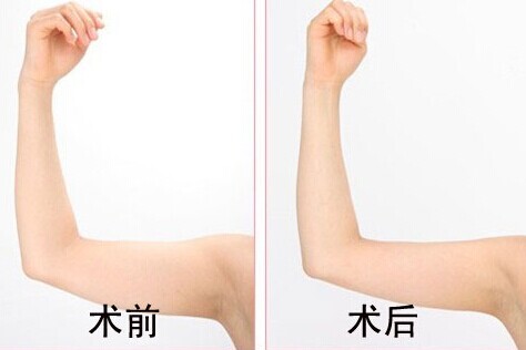 水动力吸脂,吉林铭医,长春瘦手臂