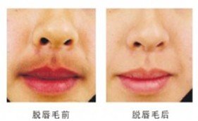 激光脱唇毛,吉林铭医