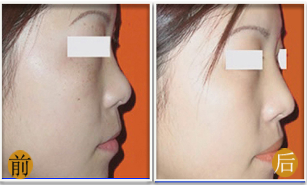 长春隆鼻,吉林铭医,铭医整形