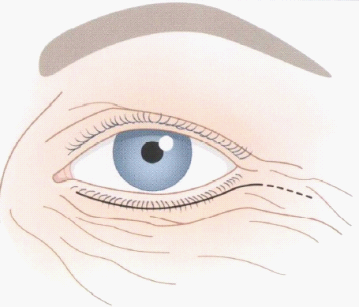 眼袋,整形,激光,吸脂 眼袋,整形,激光,吸脂