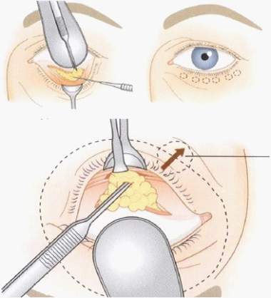 眼袋,整形,激光,吸脂 眼袋,整形,激光,吸脂