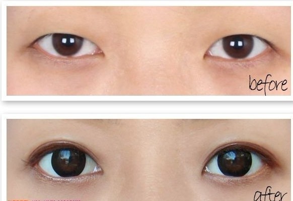 双眼皮,对比图,长春好的整形医院