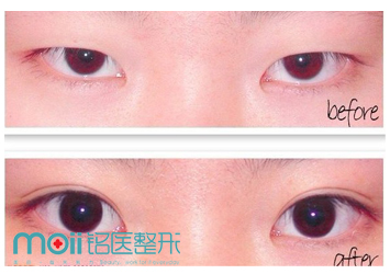 双眼皮手术