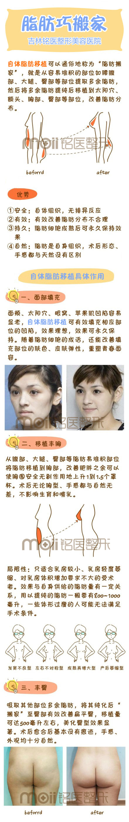 自体脂肪,移植,吉林铭医