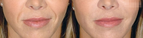 玻尿酸,吉林铭医