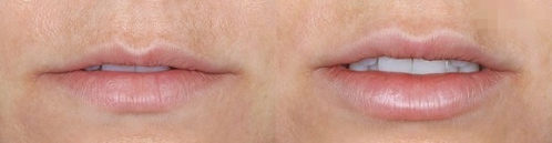 玻尿酸,吉林铭医