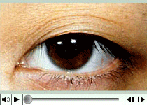 双眼皮,类型,对比图,吉林铭医