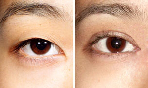 双眼皮,类型,对比图,吉林铭医