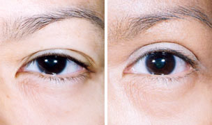 双眼皮,类型,对比图,吉林铭医