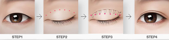 双眼皮贴,危害大,重睑术,吉林铭医