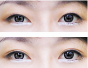 双眼皮贴,危害大,重睑术,吉林铭医