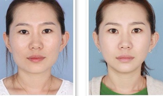 注射瘦脸针是缩小脸部的一种常用的手术方法。既然被称为手术,术后就会有一些禁忌,包括4小时内不能沾水,为的是避免针眼的皮肤外感染,还有术后一段时间内的饮食禁忌。>>>手术瘦脸 圆你精致小脸梦 注射瘦脸针后的饮食禁忌: 既然有针眼,尤其是在脸部,防止感染是至关重要的。BOTOX注射瘦脸后在饮食上也要格外注意,海鲜、辛辣刺激的食物、牛肉羊肉都不要进食避免局部肿胀。 还需要提醒的是,在口服药方面也要格外的注意,BOTOX注射瘦脸一周内不要口服抗生素,阿司匹林会加强毒素的作用,省得在面部生成反作用效果以及BOTOX瘦脸注射效果不佳。 BOTOX一般注射三到七天就有效果了,然而这种瘦脸效果一般持续四至六个月就失效了,所以BOTOX瘦脸是个长期持续的过程。注射停止意味着,亮丽的停止,脸上的赘肉会慢慢的显现出来。 整容是个人自身的选择和对美丽的追求,所以打瘦脸针无可厚非,但是需注意术后各种禁忌,避免踩中“雷区”,引发后遗症麻烦。