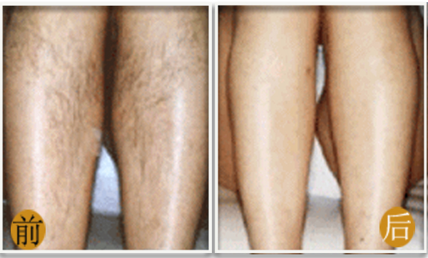 激光脱毛,持久脱毛