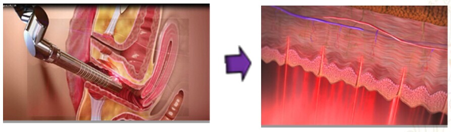 菲蜜丽,私密,青春激光,吉林铭医