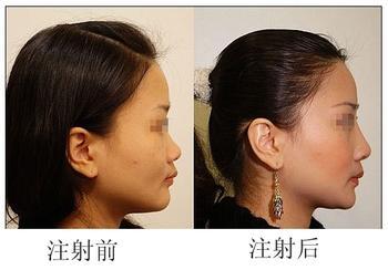 玻尿酸,隆鼻,吉林铭医