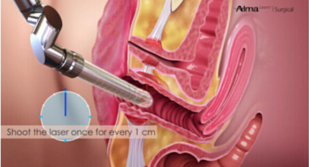 菲蜜丽,私密,青春,激光,尿失禁,吉林铭医