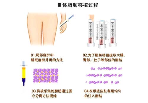 丰胸,隆胸,自体脂肪移植,吉林铭医