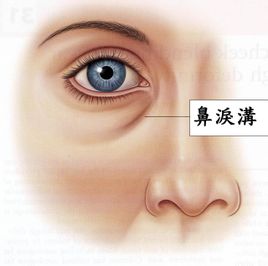 泪沟,玻尿酸,吉林铭医