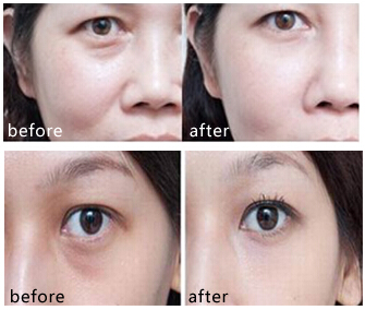 泪沟,玻尿酸,吉林铭医