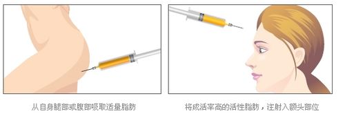 丰额头,假体,注射,自体脂肪