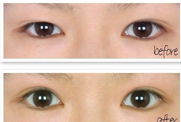 长春割双眼皮的方法有哪些