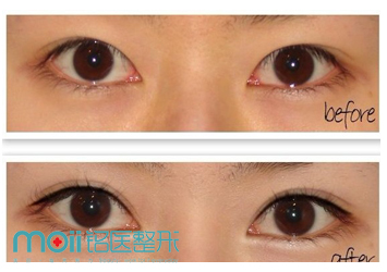 吉林铭医整形双眼皮对比图