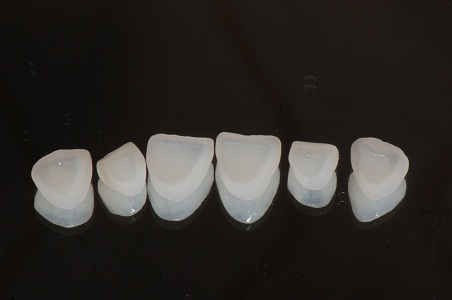 瓷贴面,优点,吉林铭医