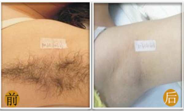 持久脱毛让肌肤光滑白皙