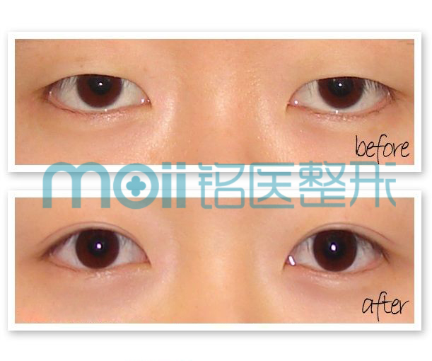 对比图,长春好的整形医院